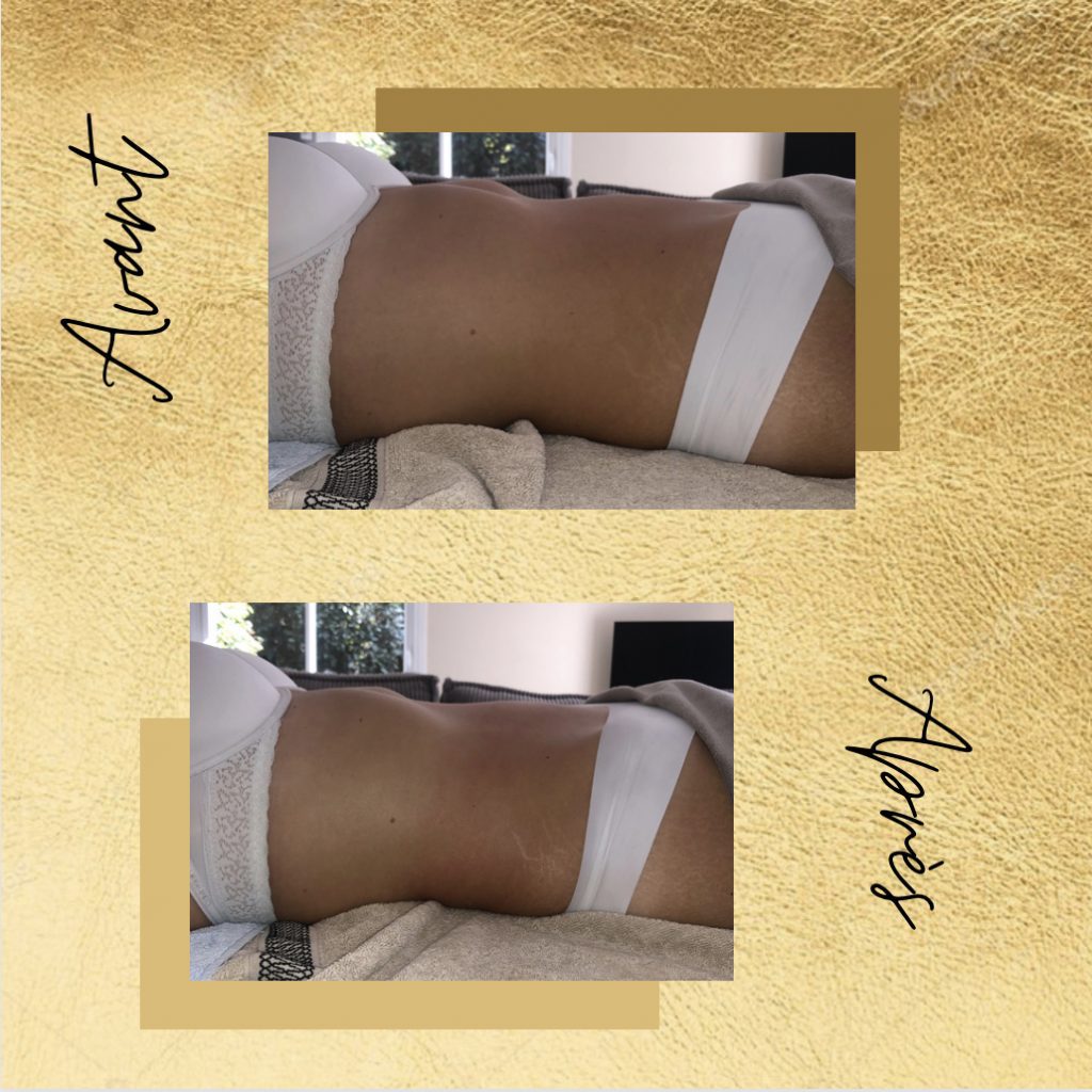 avant après drainage lymphatique